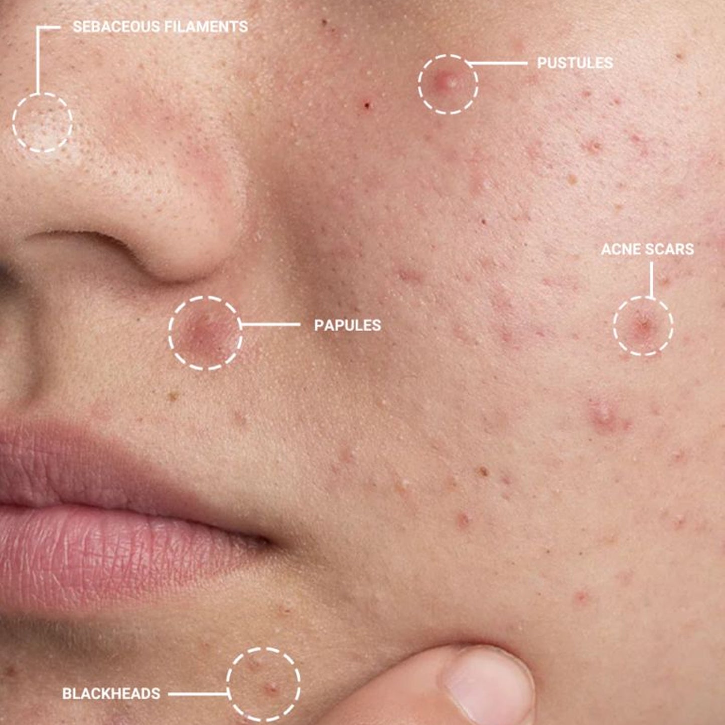 Blemish Tool Kit (Blackhead Remover)